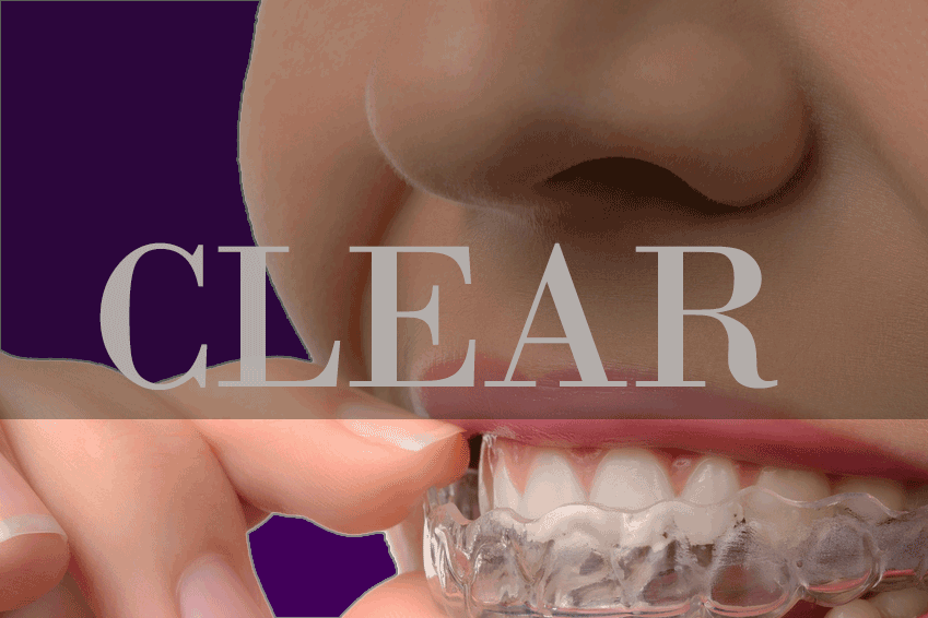 9 Things To Actually Know Before Selecting Clear Aligners